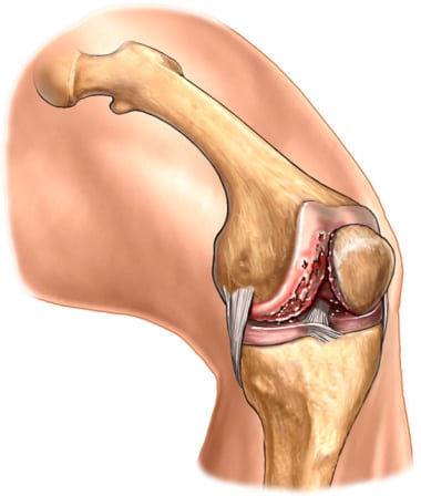 Viêm khớp nhiễm khuẩn