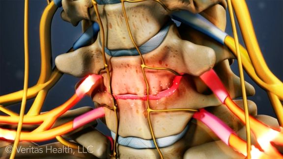 Bệnh thoát vị đĩa đệm cần tác động lên đoạn cột sống thắt lưng có thoát vị đĩa đệm