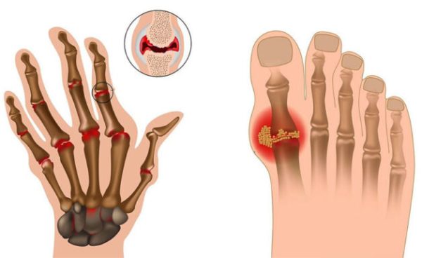 triệu chứng viêm khớp nhiễm khuẩn