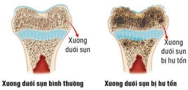 Hình ảnh xơ xương dưới sụn 